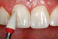 Composite resin restorations, e.g. made of Tetric EvoCeram, can be easily polished to an ideally smooth surface finish and a long-lasting natural-looking lustre. Dr M.
