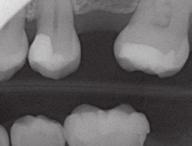 It signficantly facilitates the diagnosis of any secondary caries under Tetric Evo materials.