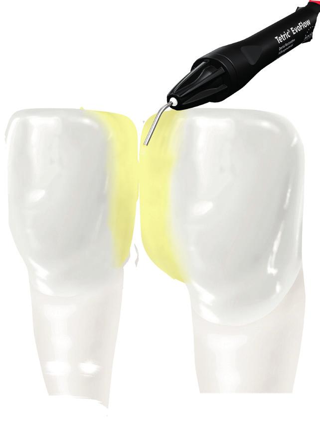 reach making it suitable as an initial layer in posterior restorations.