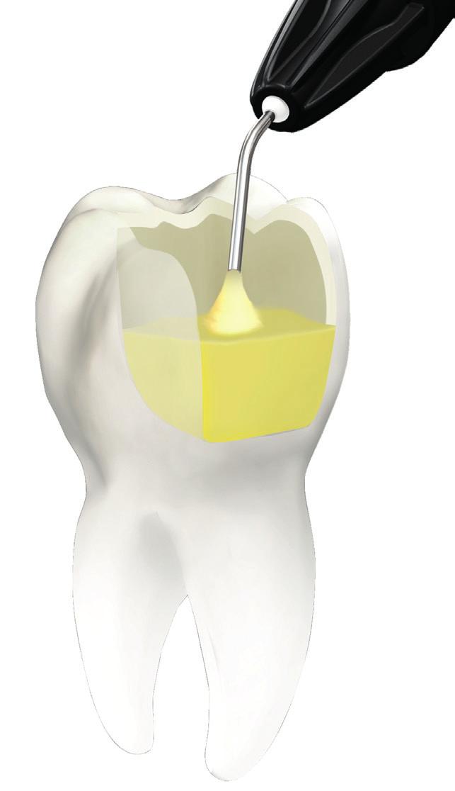 placed with Tetric EvoFlow Bulk Fill to be both more efficient and more esthetic.