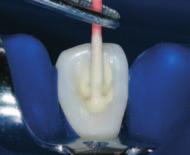 Because of the excellent tissue tolerance of Apexit Plus, a biological balance is re-established around the tooth after the