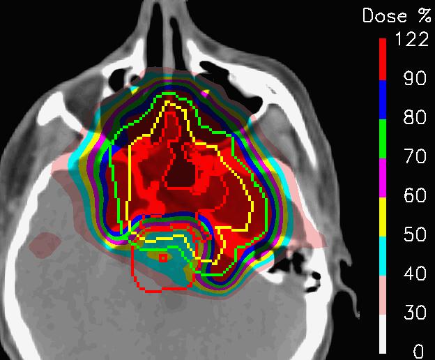 Proton-Radiotherapy for skull base tumors: 2 tumor (target
