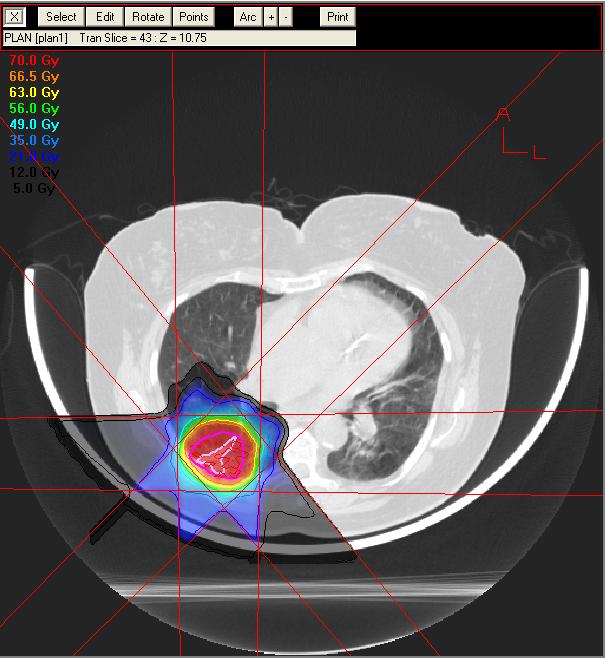 Hypofractionated Proton Beam Radiotherapy for Stage I Lung Cancer. Bush et al.