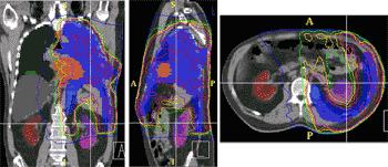 Radiotherapy for