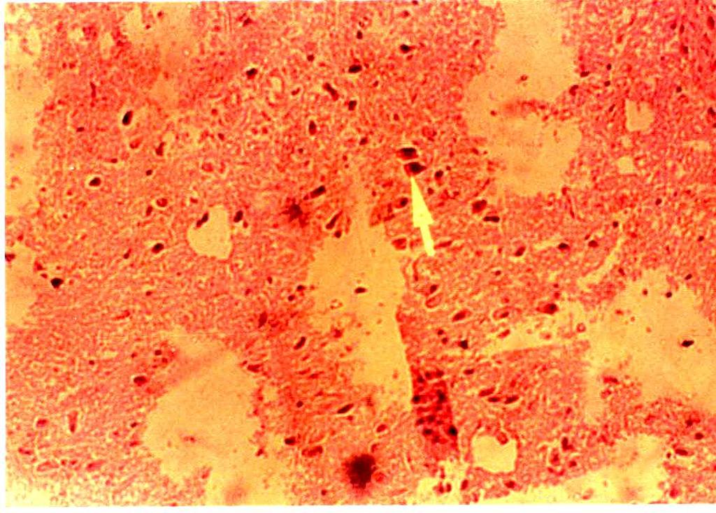 Ezekwesili et al. 1320 Figure 16: The brain section of rat dosed 100 mg/kg wt daily for 28 days showing the same nuclear hyperchromasia, chromatolysis and nuclear eosinophilia.