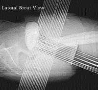 X-rays HDR prostate implant: