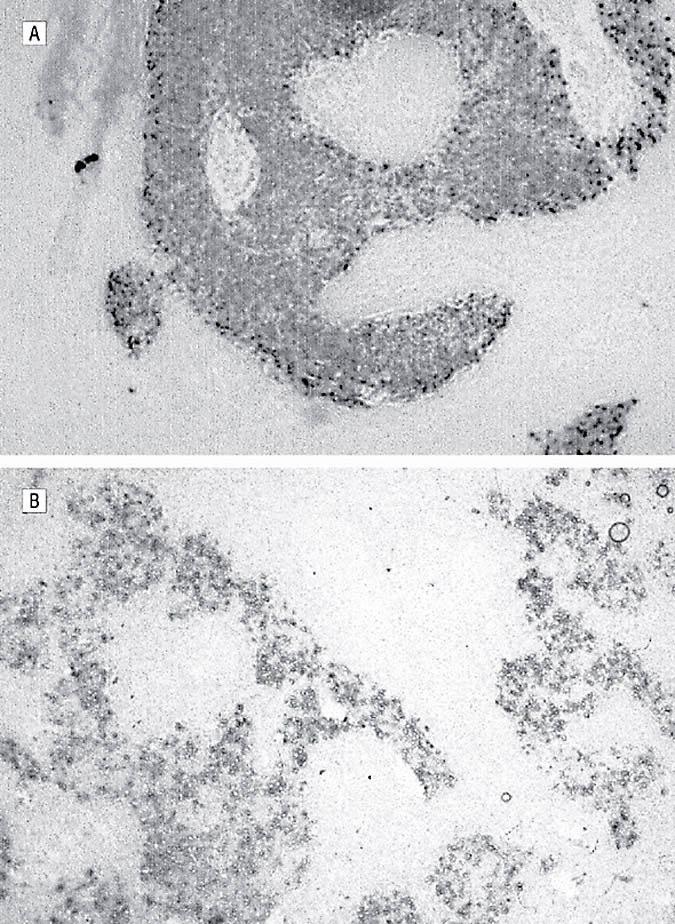 In situ Hybridization with an Epstein- Barr Virus encoded Small RNA Neck