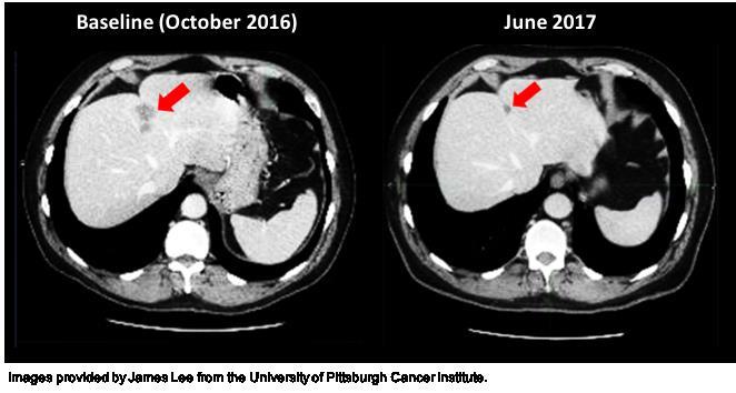 Reductions in Metastatic Lesions and Tolerable Safety Profile Liver Metastases 58-year-old male: 3 prior chemo regimens Lung Metastases 63-year-old male: 4 prior chemo regimens Safety Profile: Safety