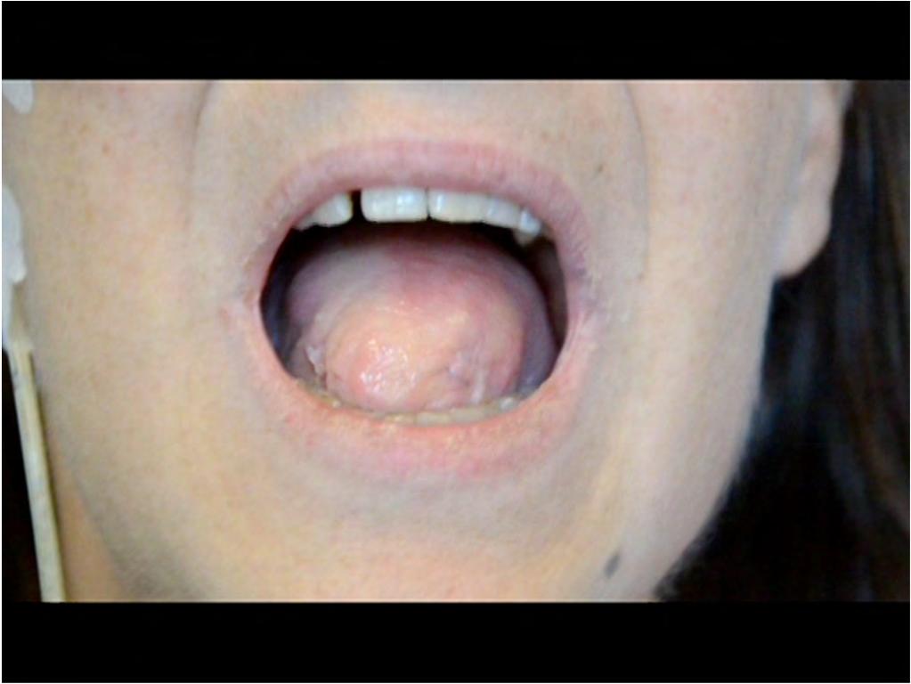 Near-total tongue