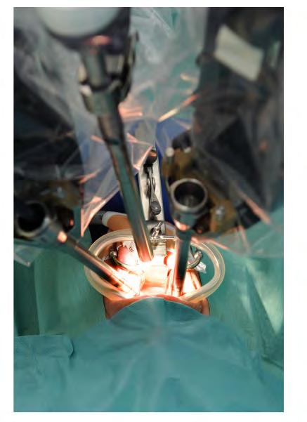 Robotic surgery for the supraglottic larynx 18 pts.