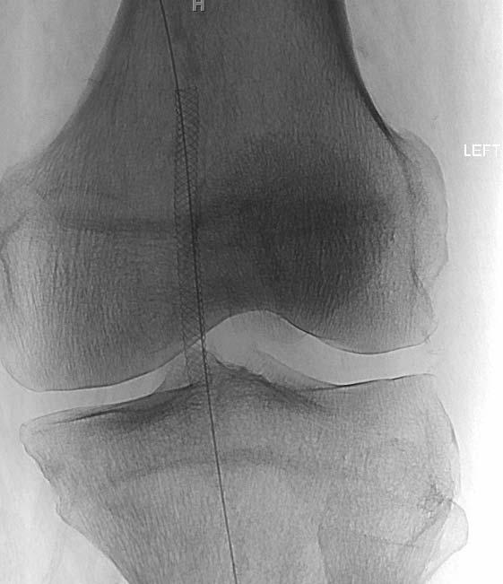 CRITICAL LIMB ISCHEMIA: DIAGNOSIS AND CURRENT MANAGEMENT FIGURE 2 Supera stent in the mid popliteal artery. underwent an SFA to DP bypass using cephalic vein, as he had no usable leg veins.