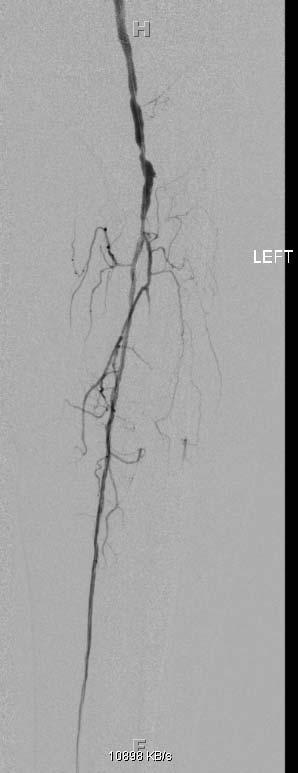 FIGURE 3 Completion angiogram. Not the significant improvement in flow through the PT, the AT fills via collaterals, but in a more delayed fashion.