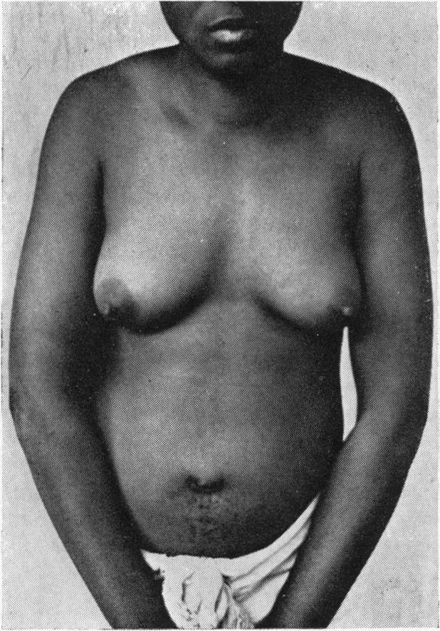 FIG. 1.-The general body configuration of Dominico showing the well-developed breasts (Case 1). found, but there was no vagina.