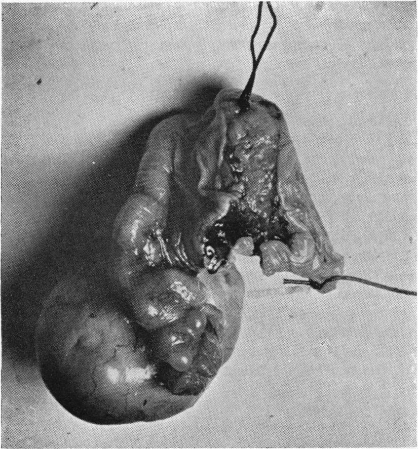 The position was explained to the patient and, with his consent, the uterus, tube, and ovary were removed (Fig. 2).
