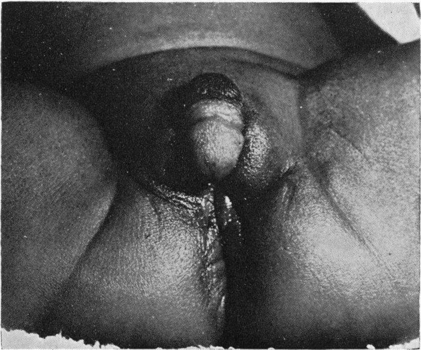 .Hermaphrodites FIG. 3.- The external genitalia of Maria (Case 3). Intersex Among Africans in Rhodesia common urogenital sinus opening on to the perineum (Fig. 4).