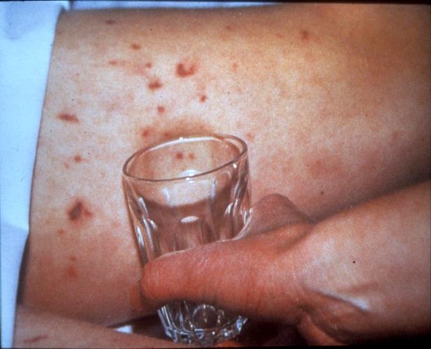 Figure 1 a non-blanching rash (Photo courtesy of the Meningitis Research Foundation) However, the rash can appear late in the illness or not at all, so if your child has the other symptoms, do not