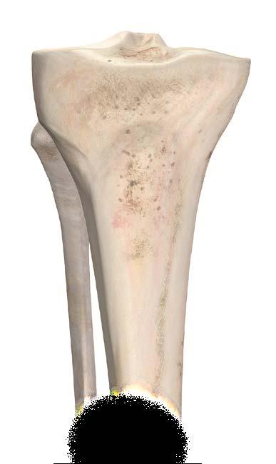 SURGICAL TIPS AND PEARLS Tibial Resection Guide a. The tibial guide s primary reference surface is the anterior/medial aspect of the tibia.