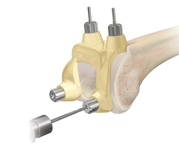The anterior holes will be used to place the HP distal femoral cutting block to perform the distal femoral cut.