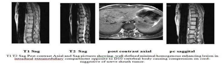 MRI showed extradural soft tissue anterior to the cord extending from C2-C4 level causing compression on the spinal cord.