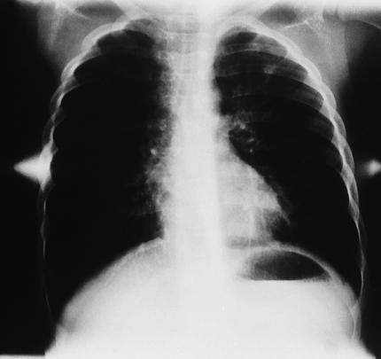 Radiologic Findings Chest radiograph Increased anteroposterior diameter (barrel chest) Translucent (dark) lung fields Depressed or flattened diaphragms GINA The Global Ini:a:ve for (GINA) was