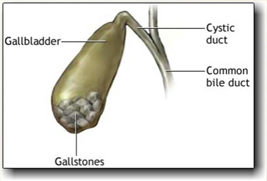 CHOLECYSTITIS Inflammation of gallbladder CHOLELITHIASIS Gallstones Can block the bile duct causing pain and digestive