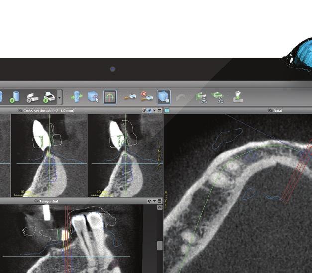 DIGITIZE YOUR WORKFLOW AND TAKE ADVANTAGE OF EXCITING OPPORTUNITIES codiagnostix is the dental implant planning software