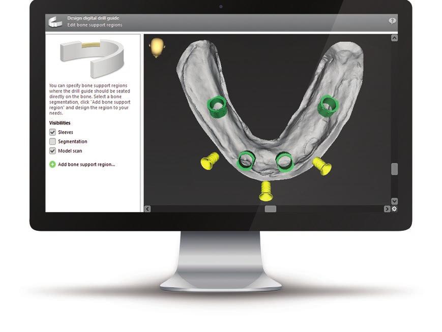KEY FEATURES Comprehensive library with implant systems from all major manufacturers and many sleeve and guided systems. Own elements/systems can be added.