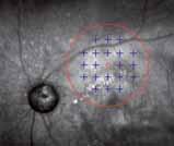 Thanks to its combined structurefunction analysis, microperimetry represents an essential tool for: Deriving the correct diagnostic decision in a variety of retinal diseases Monitoring the