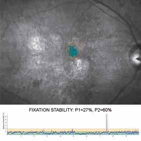 During the progression of the pathology, the PRL may evolve towards a retinal area that lacks the optimal characteristics for eccentric viewing, resulting in unstable fixation.