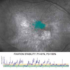 FIXATION STABILITY: P1=27%, P2=60% 6 7 Interpolated sensitivity map over full SLO image Fixation Plot over zoomed SLO image and PRL identification 6 10 11 MAIA PRL training can help eye care