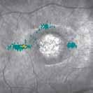 Macular Pucker Traction lines, clearly visible on the SLO image and localized functional losses explain reported visual discomfort.