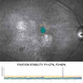 In severe forms, when the foveal area is affected, central vision is lost, fixation capability is weakened and visual quality may be heavily reduced (low vision).