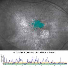 During progression of the pathology the PRL may evolve towards a retinal area that lacks the optimal characteristics for eccentric viewing, resulting in unstable fixation.