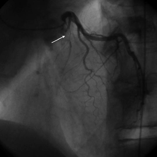 A B C D Fig. 2. 62-year-old man with single-vessel coronary artery disease.