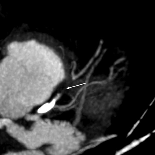 C, Vascular stenosis of end branches of right coronary artery can be excluded on