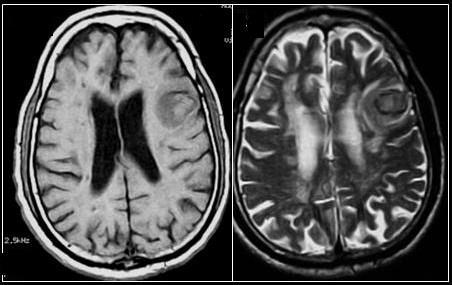 Acute Hematoma MR images show an acute hematoma in the left frontal region.