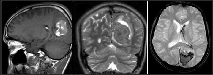 Early Subacute Hemorrage MR images show early subacute hematoma in the left occipital region.