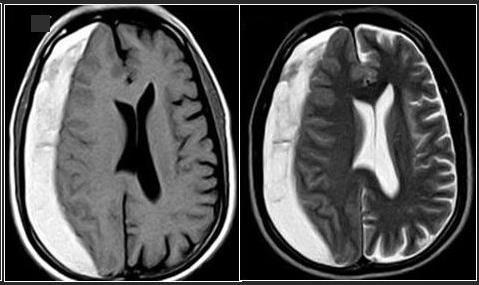 Late Subacute Hematoma Late Subacute subdural hematoma Both T1-weighted (T1W) and T2-