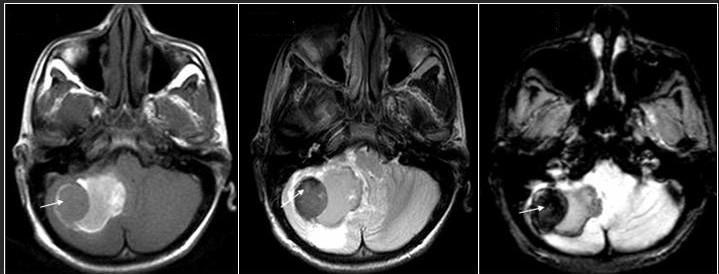 Chronic Hematoma MR imaging shows a late subacute to chronic hematoma as a spaceoccupying lesion in the right posterior fossa.