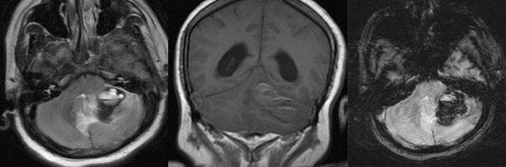 Various Ages Hematoma Hemorrhages of various ages are seen in the left cerebellar hemisphere with blood-fluid levels in a patient on anticoagulation therapy for