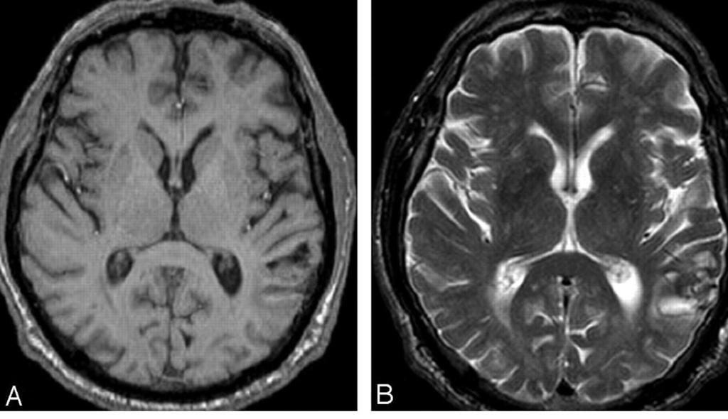 SWI Susceptibility-weighted imaging (SWI) is a neuroimaging