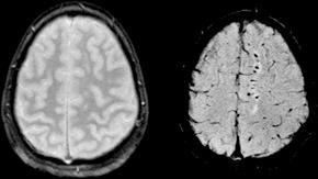 Comparison of diffuse axonal injury (DAI) imaged with conventional GRE (left) and SWI (right) at 1.