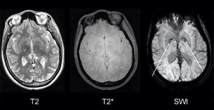Patient with multiple sclerosis (MS).