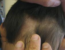 Case 2 Hair Loss on the Head A 7-year-old boy presents with localized hair loss over the occiput. On closer examination, he has several exclamation-like hairs. a. Trichotillomania b. Tinea capitus c.