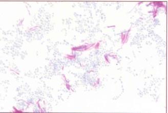 IMAGE BACTERIA SHAPE DISEASE NOTES COLOR LEN ACID FAST STAIN MYCOBACTERIUM TUBERCULOSIS Rodlike to filamentous (pleomorphic) TUBERCULOSIS Mycolic acid in the cell walls.