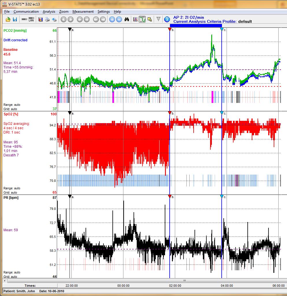 Trend Data Display within V-STATS Operator Events previously marked on the SDM during patient monitoring are displayed in V-STATS Graphic Window as colored triangles.