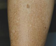 Case 4 Discolouration of the Legs A 62-year-old female presents with reddish-brown discolouration on the right and left pretibial areas of her legs.