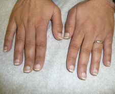 Case 5 Longitudinal Fingernail Bands A 20-year-old female is concerned about white and red longitudinal bands on her fingernails as well as some flat-topped papules in the periungual areas.