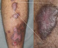 Case 6 Persistent, Pruritic Plaques A 41-year-old male presents with a history of progressive and persistent plaques on his lower legs that are intensely pruritic, violaceous, and pink in colour. a. Psoriasis b.