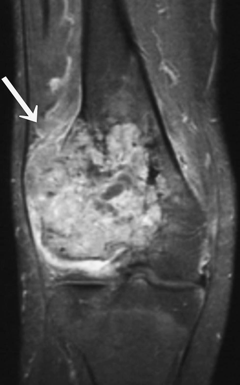 160 K. Hashimoto et al. A B Fig. 5. Coronal T1-weighted fat suppressed MR image of the right distal femur after gadolinium enhancement, in 2004.